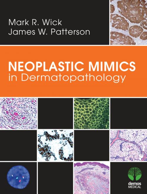 Cover of the book Neoplastic Mimics in Dermatopathology by Mark R. Wick, MD, James W. Patterson, MD, Springer Publishing Company