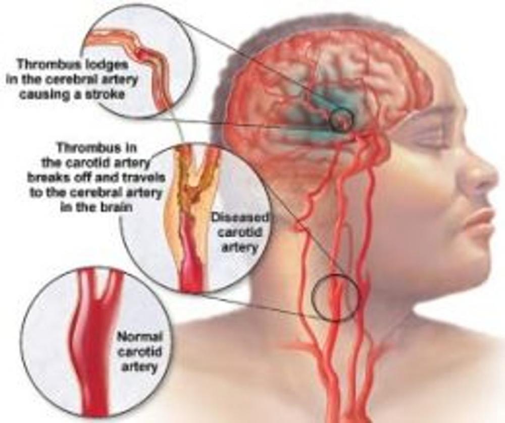 Big bigCover of Transient Ischemic Attack: Causes, Symptoms and Treatments