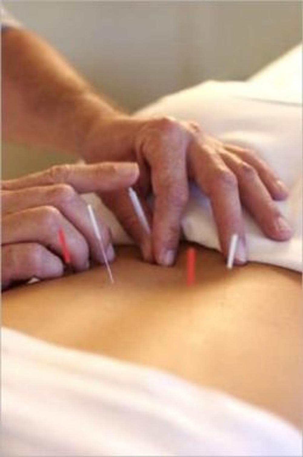 Big bigCover of Acupuncture For Beginners