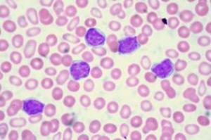 Cover of the book Chronic Lymphocytic Leukemia: Causes, Symptoms and Treatments by Hailey Gadue