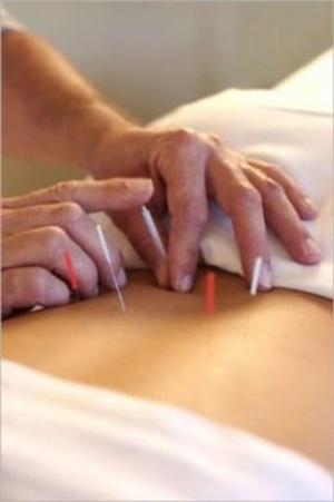 Cover of Acupuncture For Beginners