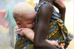 bigCover of the book Albinism: Causes, Symptoms and Treatments by 