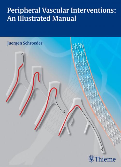 Cover of the book Peripheral Vascular Interventions: An Illustrated Manual by Juergen Schroeder, Thieme
