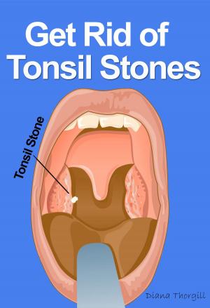 Cover of the book Get Rid of Tonsil Stones: Causes, Symptoms, Treatment, Removal and Other Remedies by Diana Thorgill