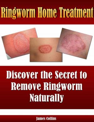 Cover of the book Ringworm Home Treatment: Discover the Secret to Remove Ringworm Naturally by Mark Reeder