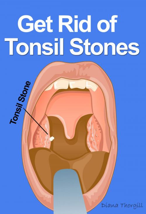 Cover of the book Get Rid of Tonsil Stones: Causes, Symptoms, Treatment, Removal and Other Remedies by Diana Thorgill, Stories of Everyday's Woe Publishing House