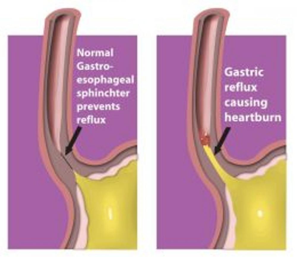 Big bigCover of Bile Reflux: Causes, Symptoms and Treatments