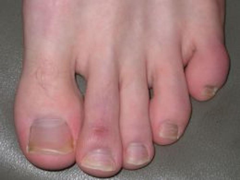 Big bigCover of Chilblains: Causes, Symptoms and Treatments
