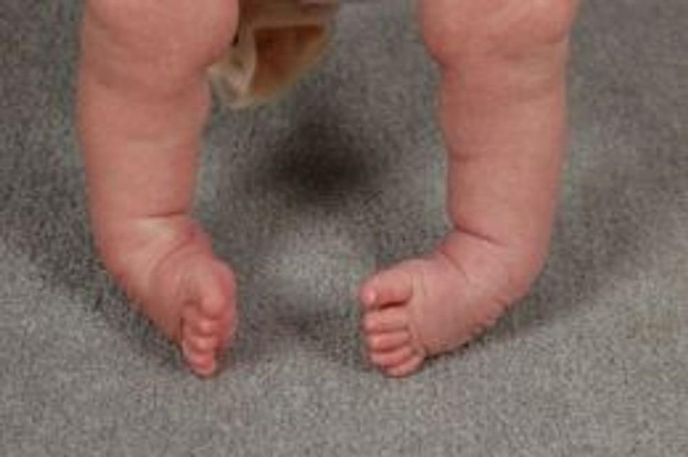 Big bigCover of Clubfoot: Causes, Symptoms and Treatments