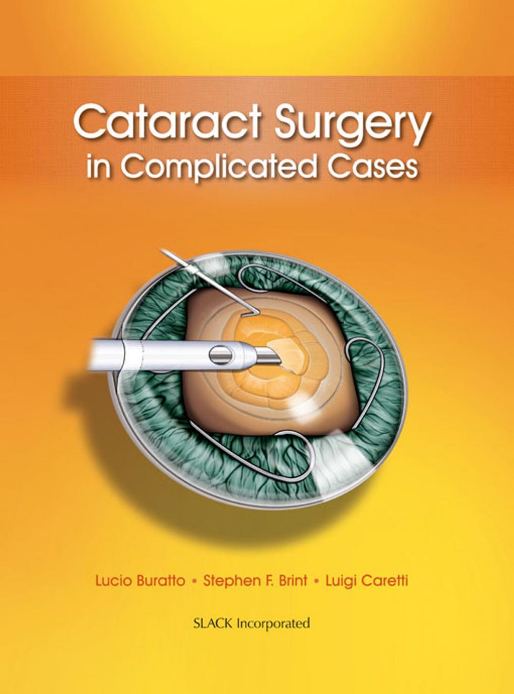 Big bigCover of Cataract Surgery in Complicated Cases
