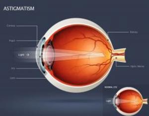bigCover of the book Astigmatism: Causes, Symptoms and Treatments by 