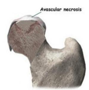 Cover of Avascular Necrosis: Causes, Symptoms and Treatments