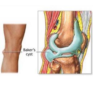 Cover of Baker's Cyst: Causes, Symptoms and Treatments