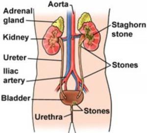 bigCover of the book Bladder Stones: Causes, Symptoms and Treatments by 
