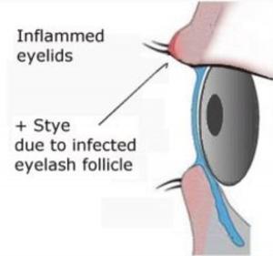 Cover of Blepharitis: Causes, Symptoms and Treatments