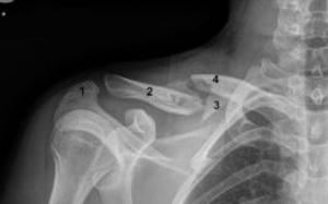 bigCover of the book Broken Collarbone: Causes, Symptoms and Treatments by 