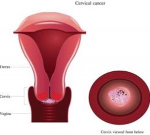 Book cover of Cervical Cancer: Causes, Symptoms and Treatments