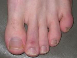 Cover of Chilblains: Causes, Symptoms and Treatments