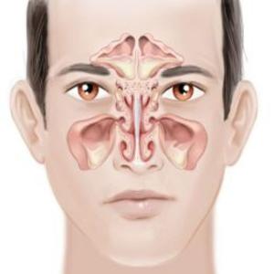 Book cover of Chronic Sinusitis: Causes, Symptoms and Treatments