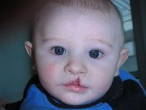 Cover of the book Cleft Lip and Cleft Palate: Causes, Symptoms and Treatments by Mac Zahn
