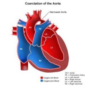 Book cover of Coarctation of the Aorta: Causes, Symptoms and Treatments