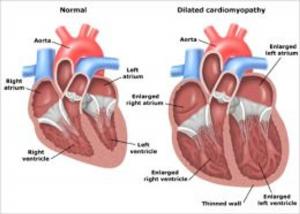 Cover of Dilated Cardiomyopathy: Causes, Symptoms and Treatments