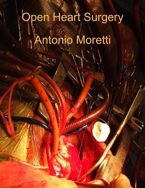 Cover of the book Open Heart Surgery by Antonio Moretti, Lulu.com