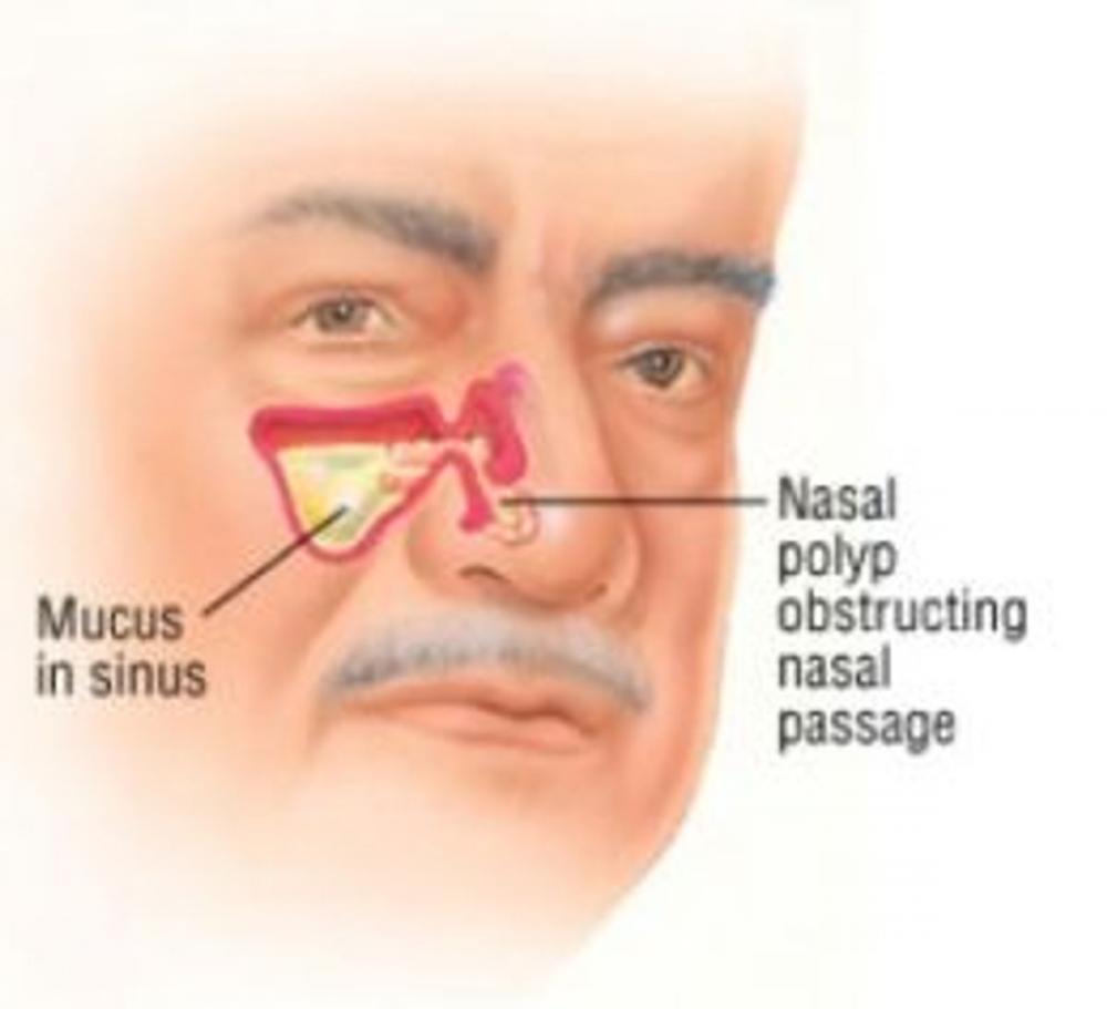 Big bigCover of Nasal Polyps: Causes, Symptoms and Treatments