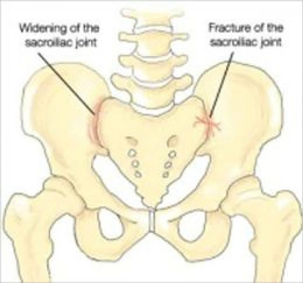 Big bigCover of Sacroiliitis: Causes, Symptoms and Treatments