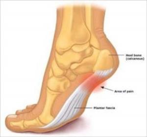 Cover of the book Plantar Fasciitis: Causes, Symptoms and Treatments by Pablo Swanson