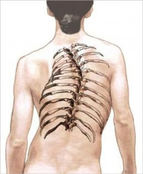 Cover of the book Scoliosis: Causes, Symptoms and Treatments by Denny Domke, Axel Publishing