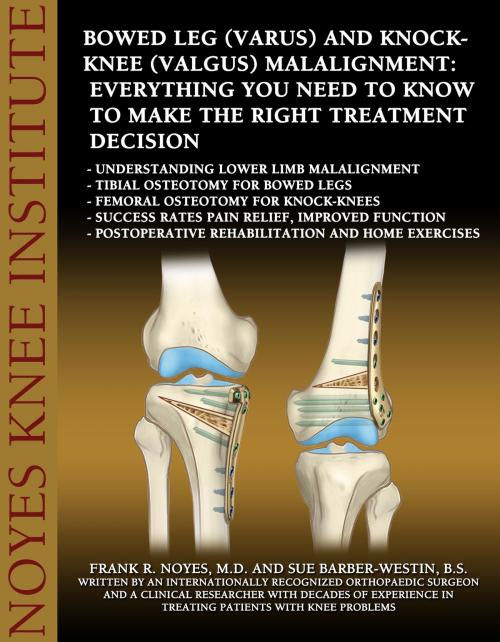 Cover of the book Bowed Leg (Varus) and Knock-Knee (Valgus) Malalignment: Everything You Need to Know to Make the Right Treatment Decision by Frank R. Noyes, M.D. and Sue Barber-Westin, B.S., Publish Green