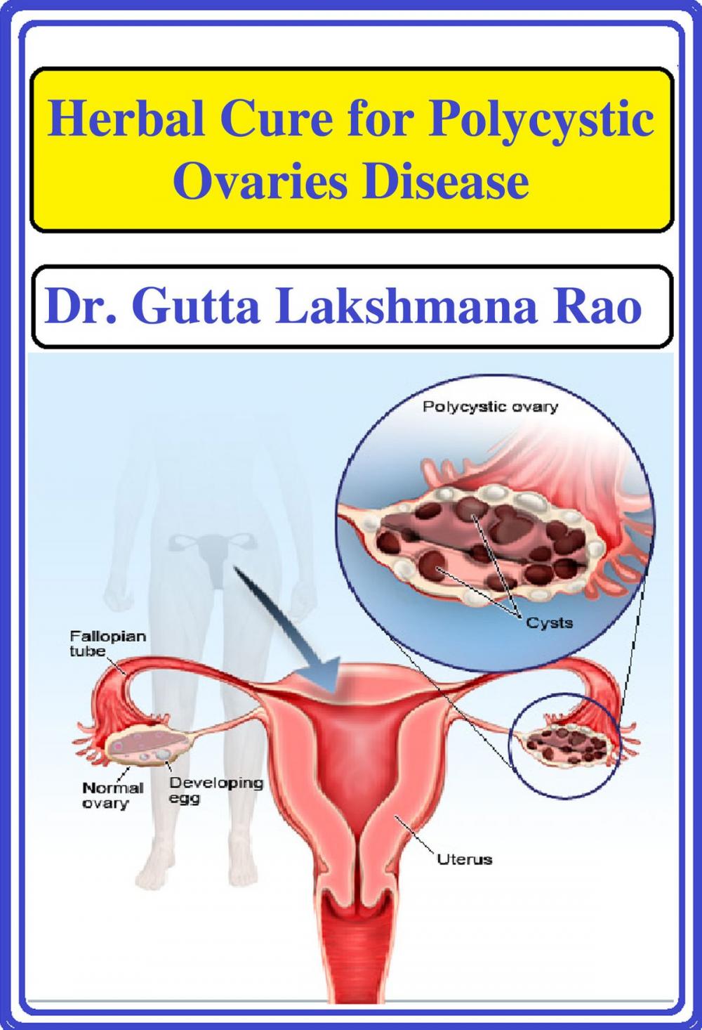 Big bigCover of Herbal Cure for Poylcystic Ovaries Disease