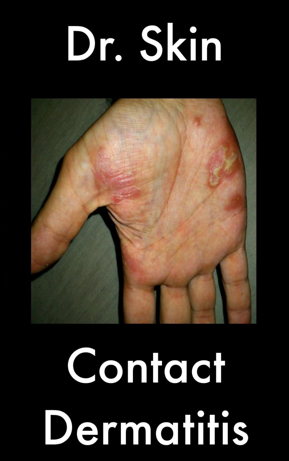 Big bigCover of Contact Dermatitis