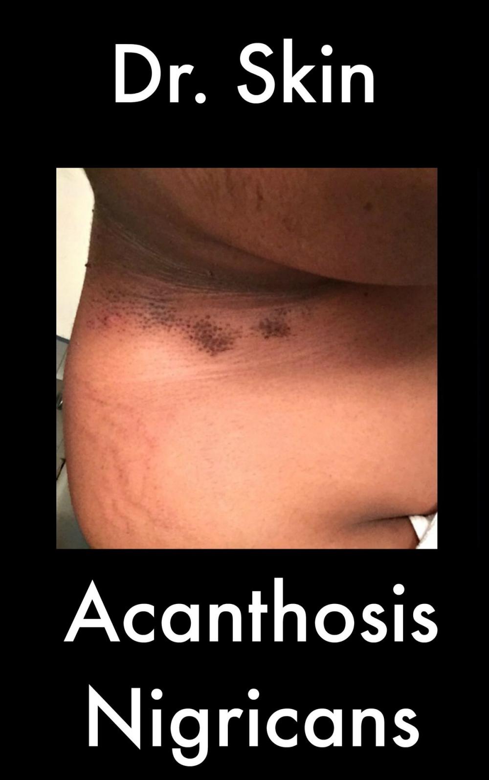 Big bigCover of Acanthosis Nigricans