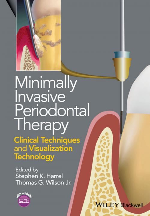 Cover of the book Minimally Invasive Periodontal Therapy by Stephen K. Harrel, Thomas G. Wilson Jr., Wiley