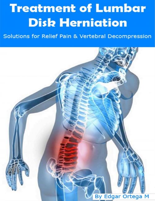 Cover of the book Treatment of Lumbar Disk Herniation by Edgar Ortega M., Lulu.com