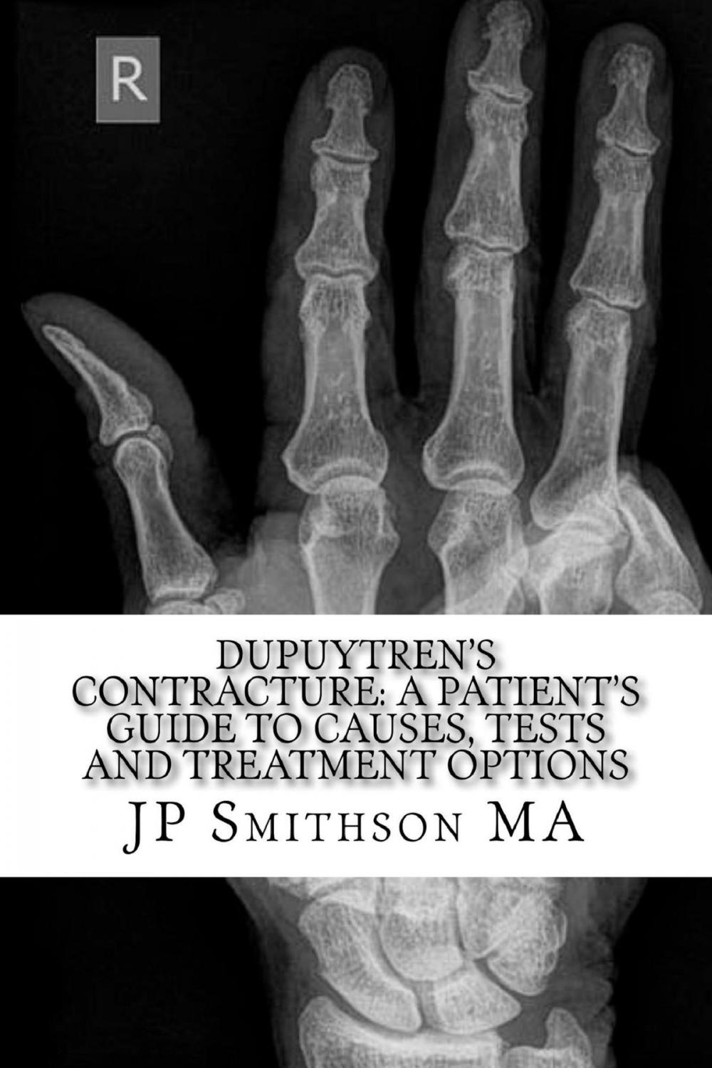 Big bigCover of Dupuytren's Contracture: A Patient’s Guide to Causes, Tests and Treatment Options