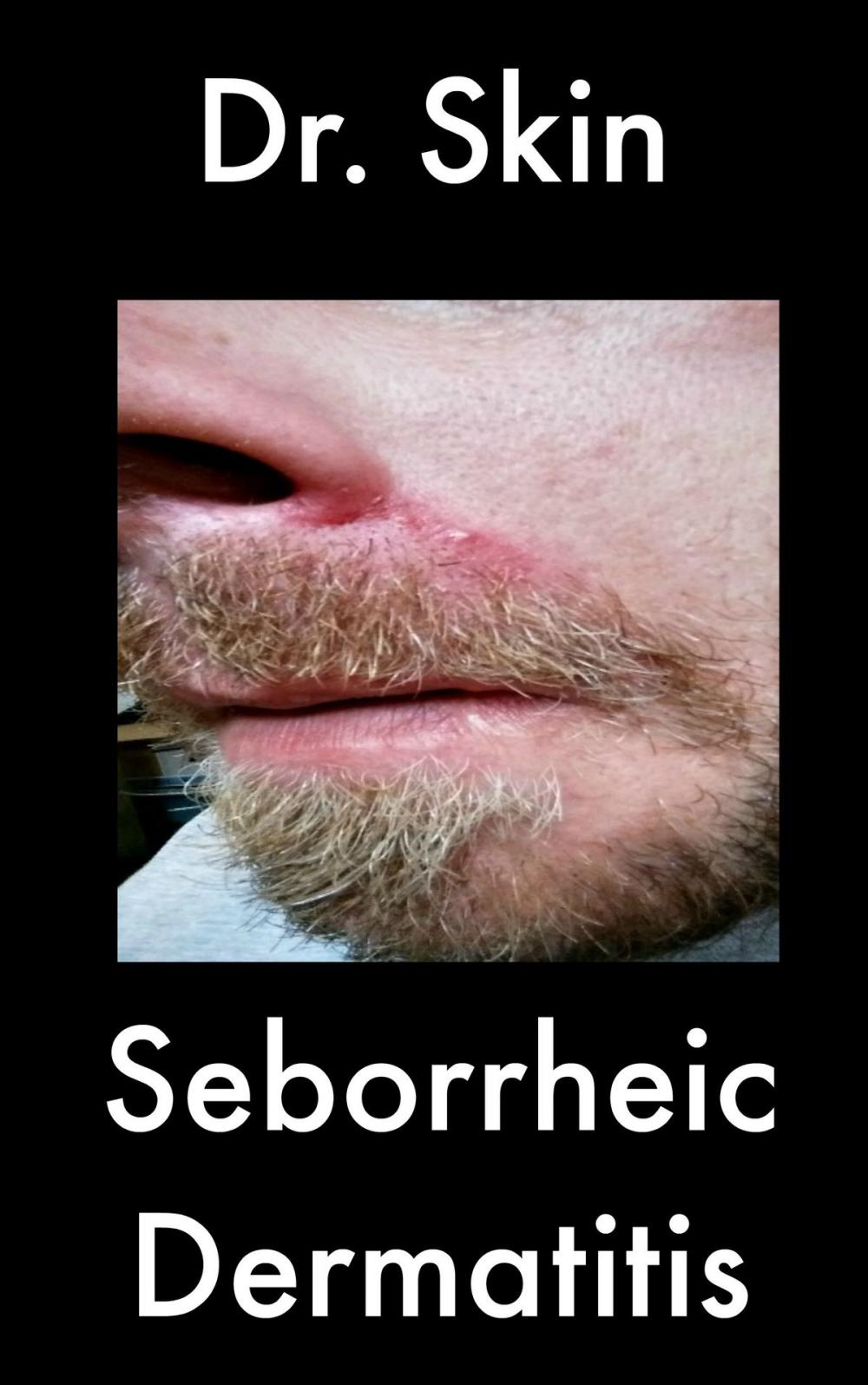 Big bigCover of Seborrheic Dermatitis