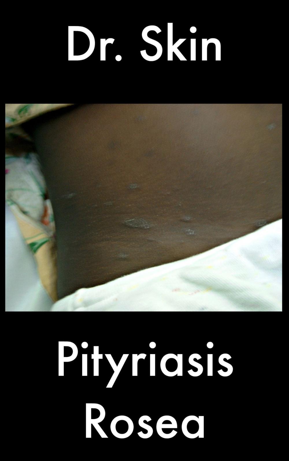 Big bigCover of Pityriasis Rosea