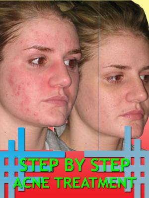 bigCover of the book Step By Step Acne Treatment by 