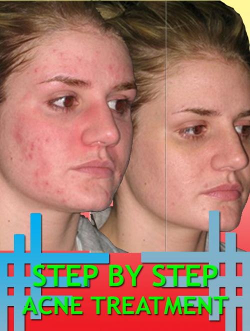 Cover of the book Step By Step Acne Treatment by Anonymous, Consumer Oriented Ebooks Publisher