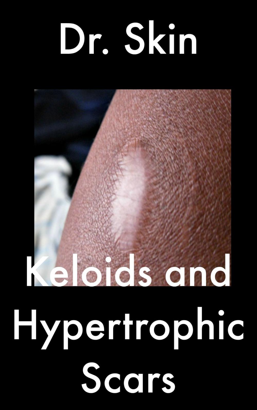 Big bigCover of Keloids and Hypertrophic Scars
