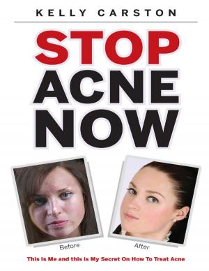 Cover of the book Stop Acne Now: This Is Me and This Is My Secret On How to Treat Acne by Dexter Morgenstern