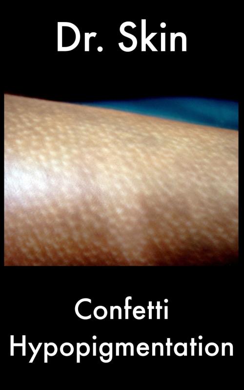 Cover of the book Confetti Hypopigmentation by Dr Skin, Dr Skin