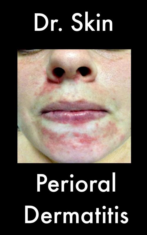 Cover of the book Perioral Dermatitis by Dr Skin, Dr Skin