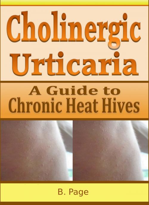 Cover of the book Cholinergic Urticaria: A Guide to Chronic Heat Hives by B Page, S.L. Page