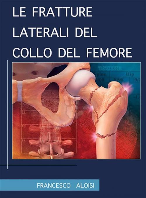 Cover of the book Le fratture laterali del collo del femore by Francesco Aloisi, Francesco Aloisi