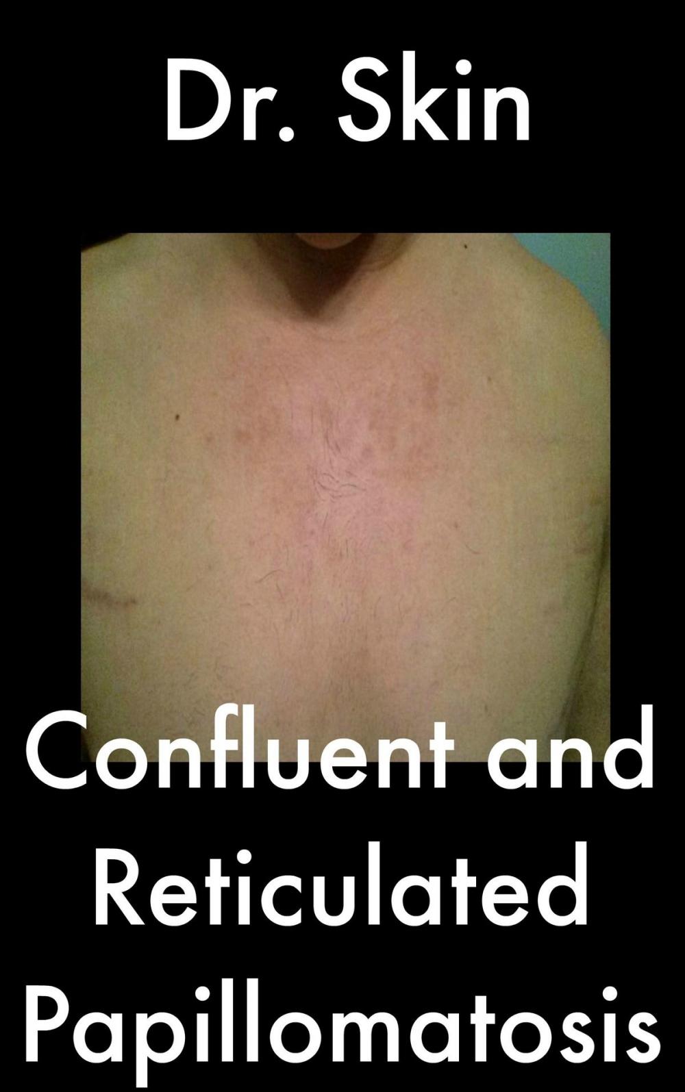 Big bigCover of Confluent and Reticulated Papillomatosis