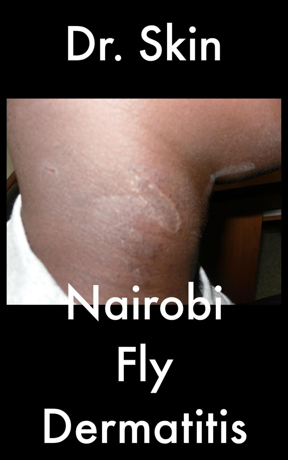 Big bigCover of Nairobi Fly Dermatitis